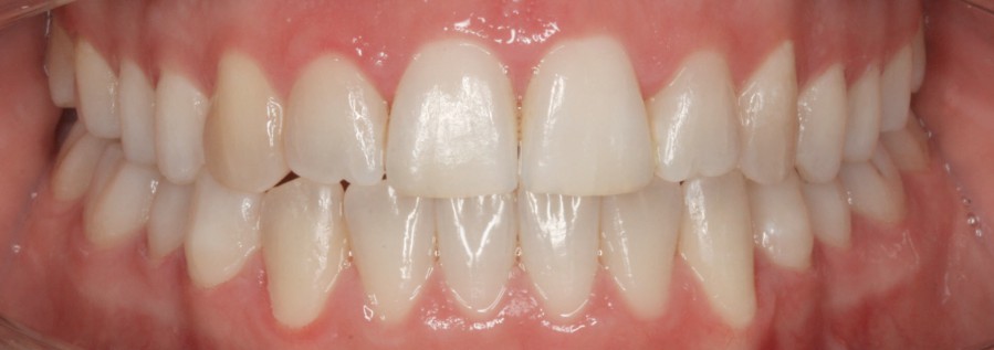 Zähne nach der Behandlung mit Invisalign Zahnspange.