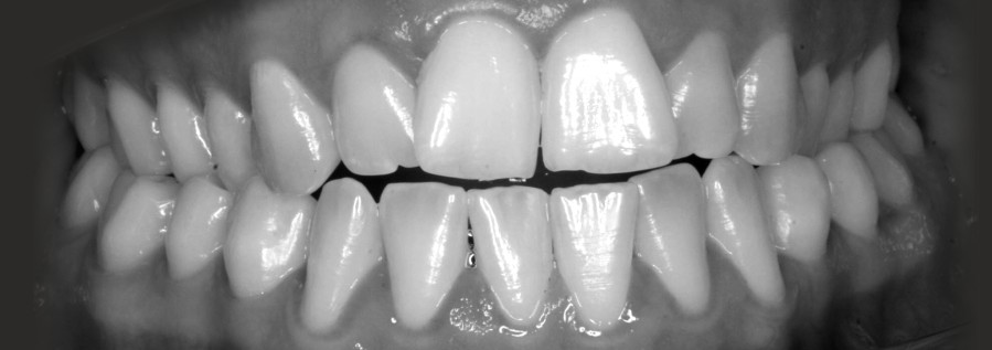 Zähne vor der Behandlung mit Invisalign Zahnspange.